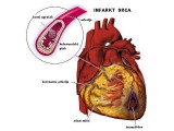 Povećava se broj infarkata - važno je brinuti na vreme!