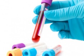 Besplatna provera lipidnog statusa