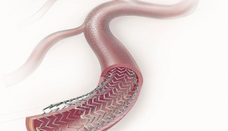 Stižu nove količine stentova