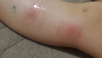 Како преживети комарце?