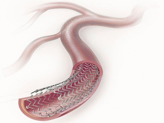 Stižu nove količine stentova