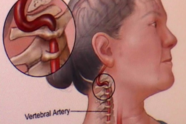 Nacionalni dan borbe protiv moždanog udara