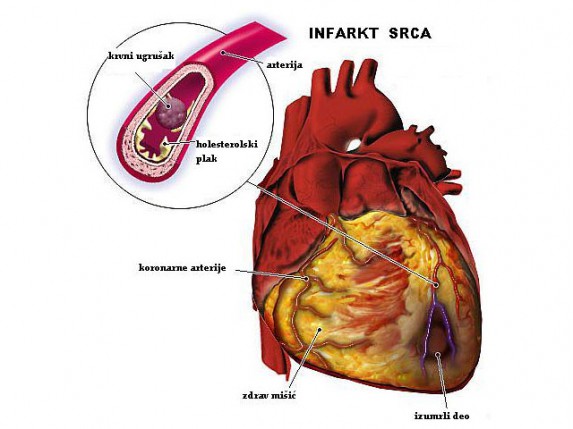 Povećava se broj infarkata - važno je brinuti na vreme!