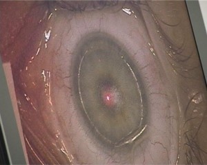 Zauvek skinuli naočare i sočiva