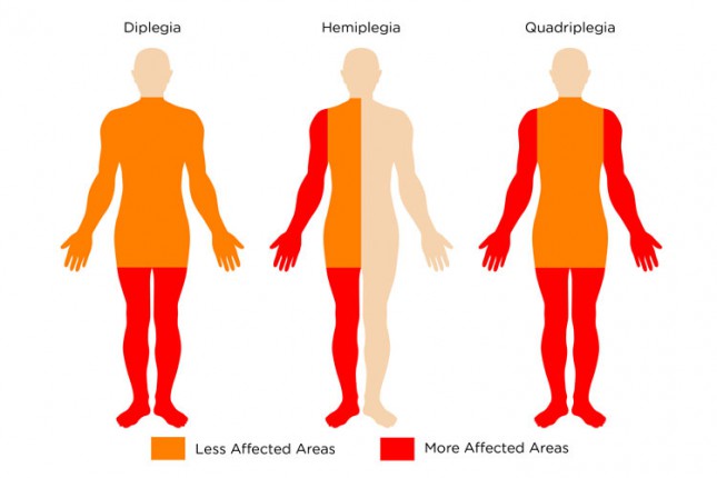 Počelo obeležavanje Nedelje solidarnosti sa osobama sa cerebralnom i dečijom paralizom