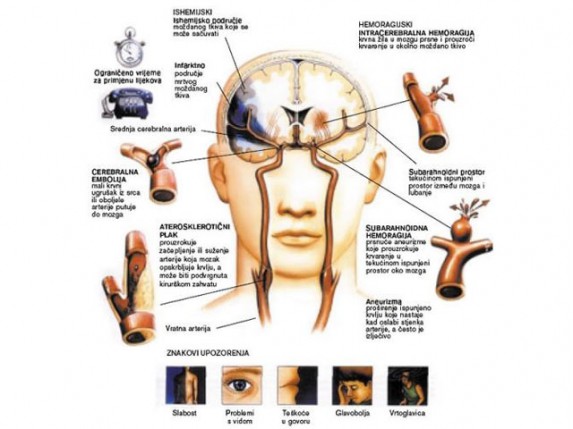 Dan borbe protiv moždanog udara