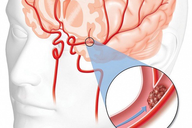 Većina moždanih udara je izlečiva, najvažnije je javiti se na vreme
