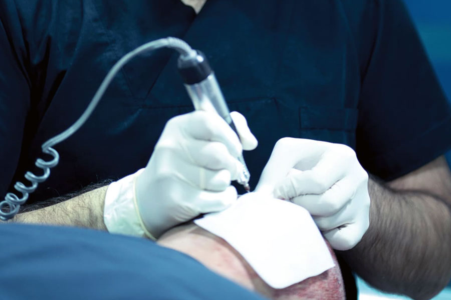 Besplatni pregledi za transplantaciju kose, obrva i brade uz letnje popuste