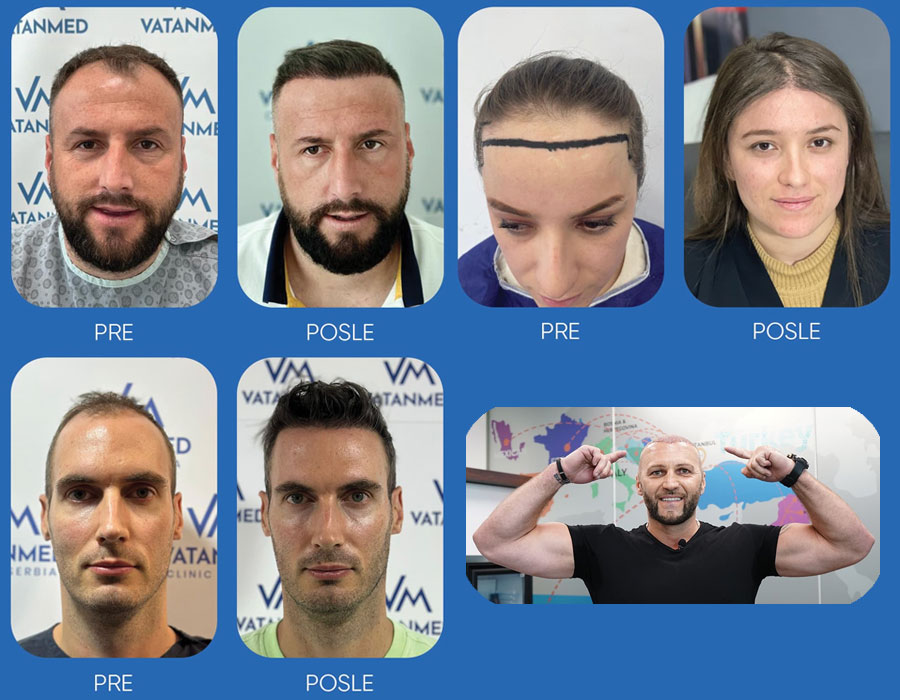 Besplatni pregledi za transplantaciju kose, obrva i brade uz letnje popuste