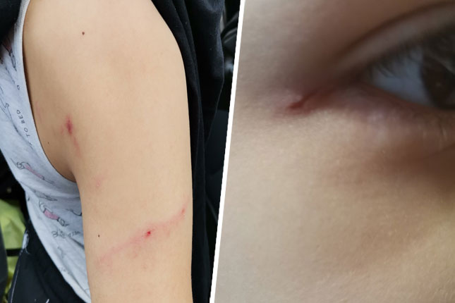 Ogorčeni roditelji dece koju su izujedali belgijski ovčari, protiv vlasnika biće podneta krivična prijava