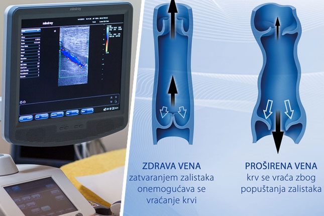 Problem proširenih vena ima čak 40 odsto naše populacije