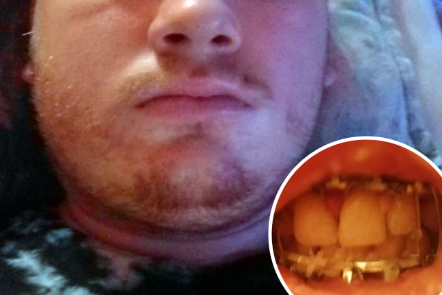 Novi slučaj vršnjačkog nasilja – mladiću polomljena vilica