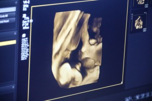 Novi 4D ultrazvuk na odeljenu ginekologije u Dispanzeru za žene